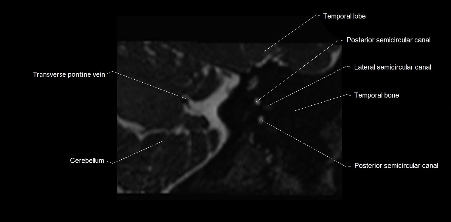 MRI Internal auditory meatus (IAM) coronal cross sectional labelled anatomy image 30.webp
